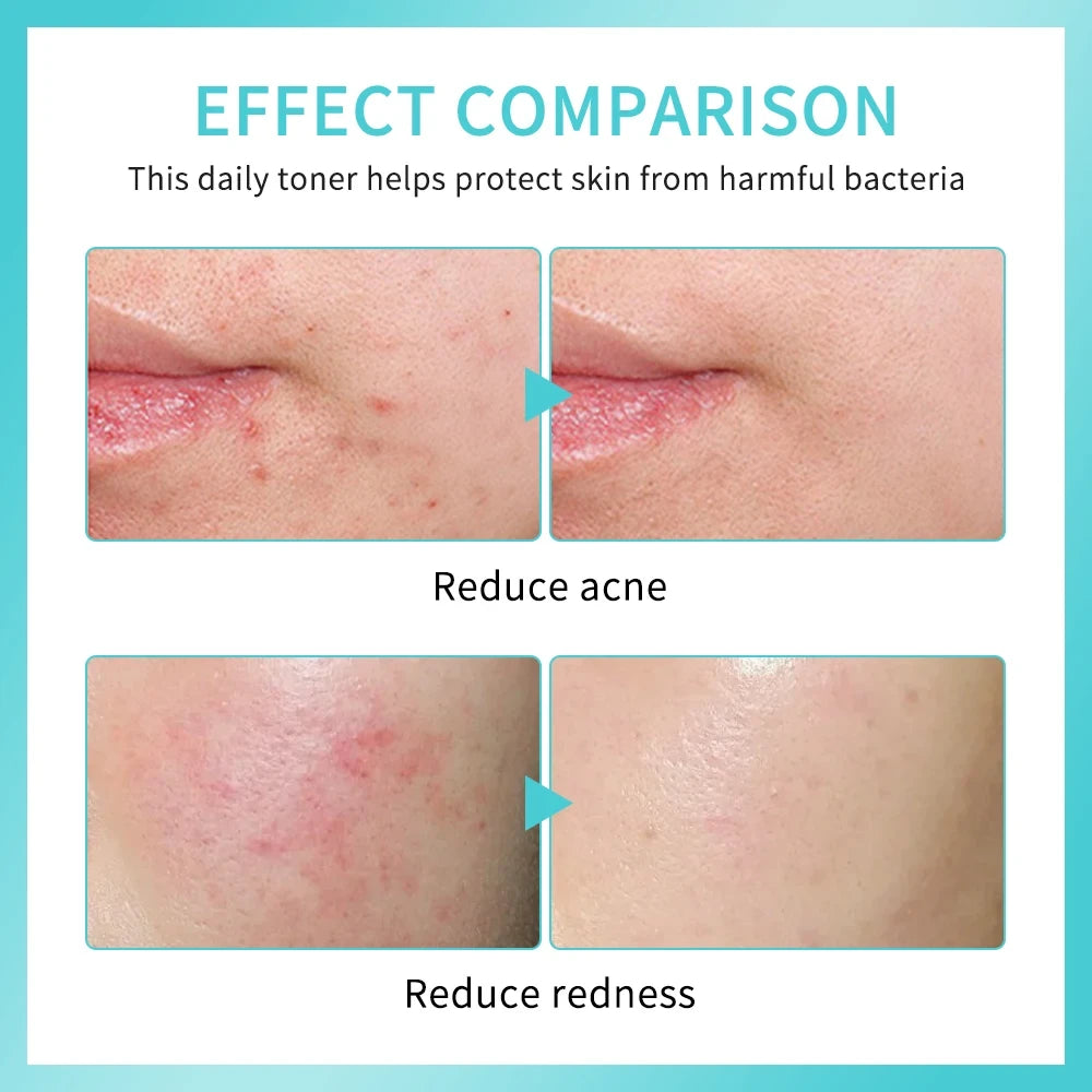 Hypochlorous Acid Facial Mist
