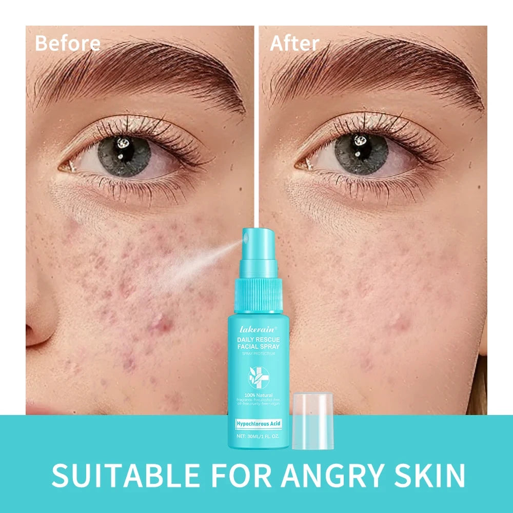 Hypochlorous Acid Facial Mist